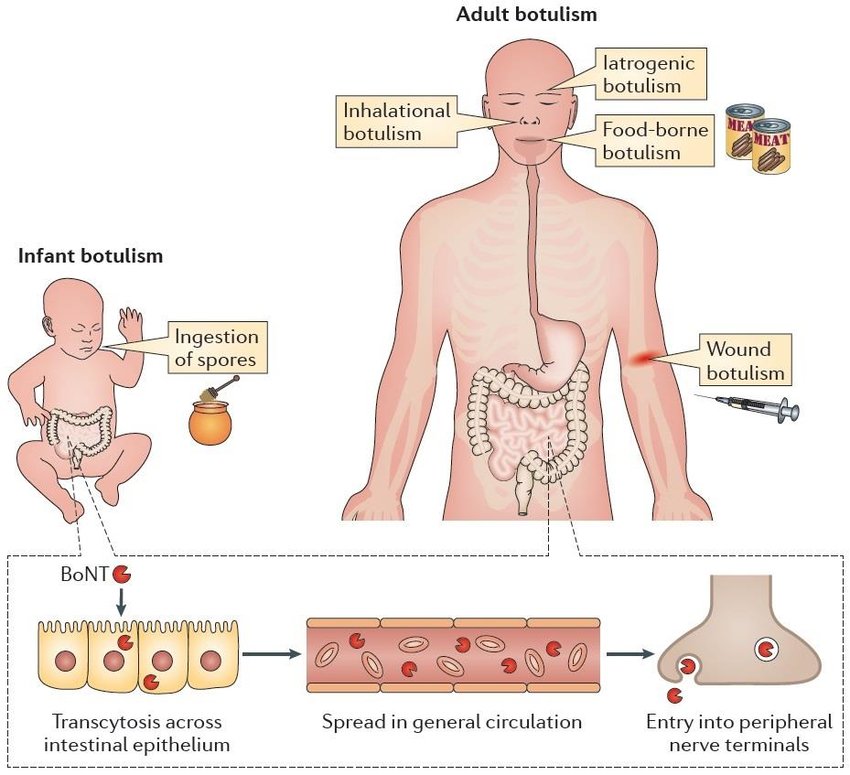 https://www.researchgate.net/profile/Cedric_Woudstra/publication/304792202/figure/fig2/AS:380429820547074@1467712945210/Human-form-of-botulism-Intoxination-due-to-consumption-of-food-contaminated- with.png