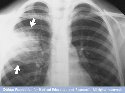 Рентгенологічне зображення легенів при пневмонії