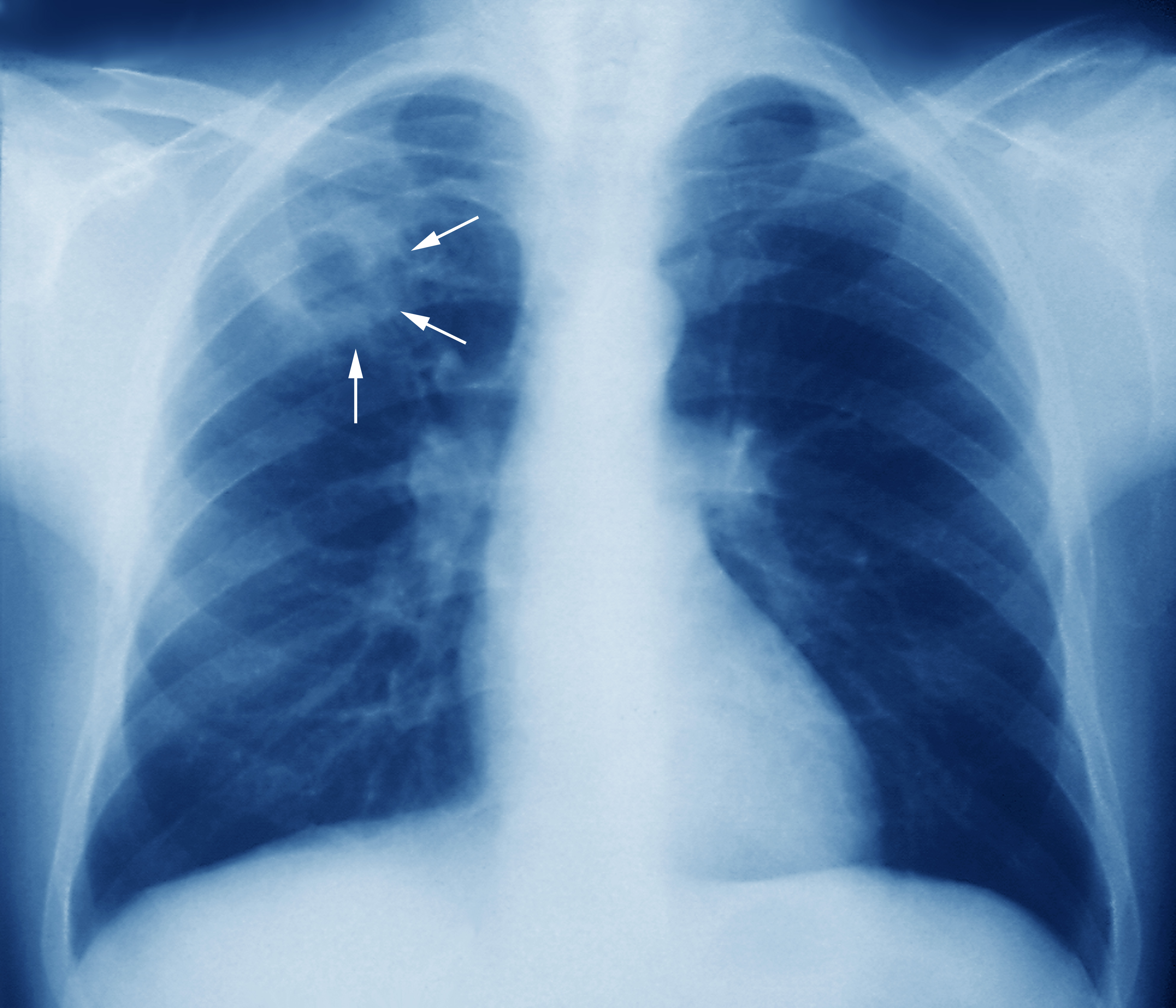 https://medukr.org/wp-content/uploads/2020/12/m2700245-tuberculosis-chest-x-ray-science-photo-library-high.jpg