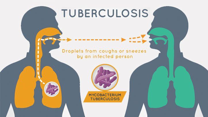 Туберкульоз: причини, симптоми та лікування